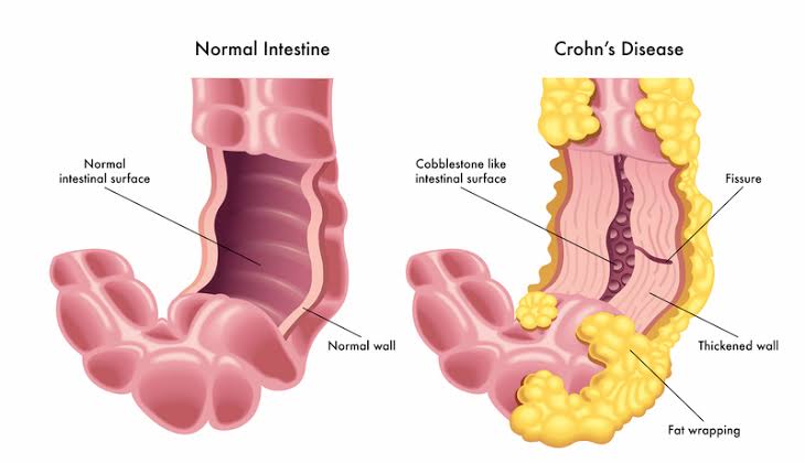 Crohn’s disease