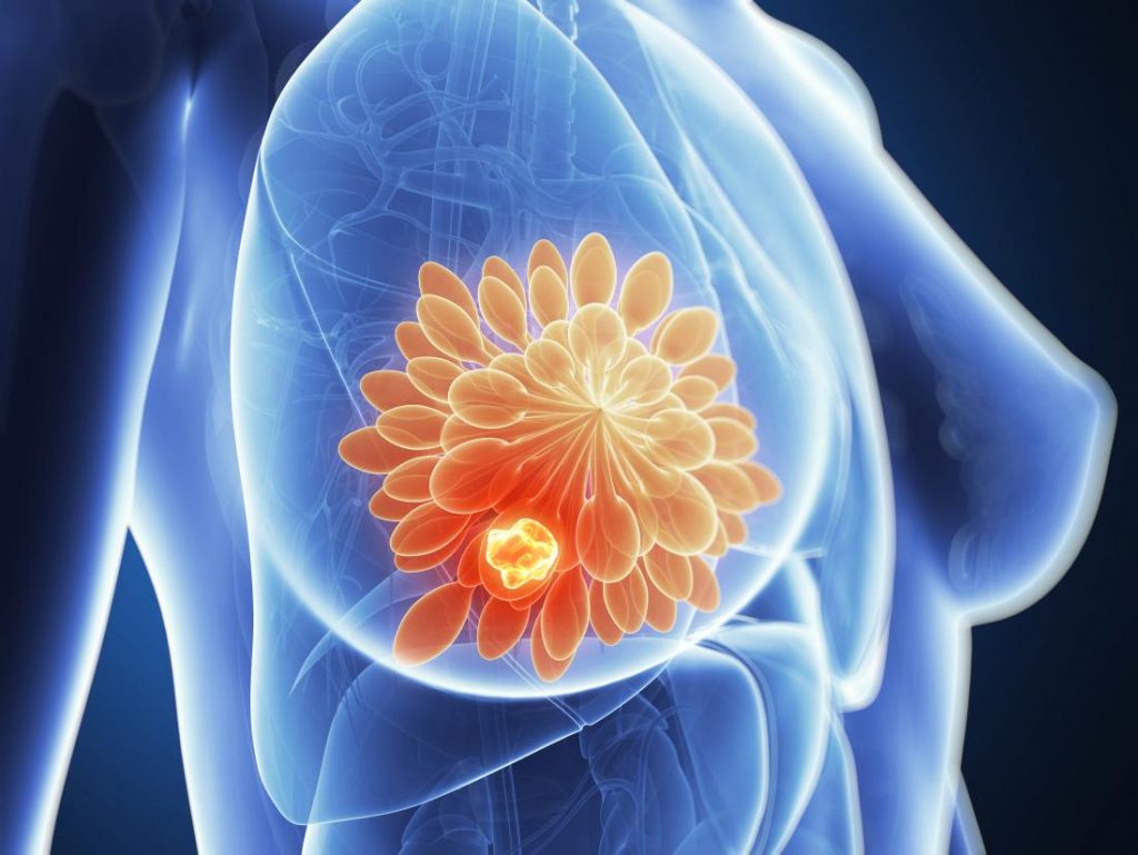 Symptoms  of breast cancer