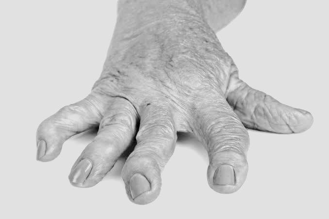 Rheumatoid arthritis