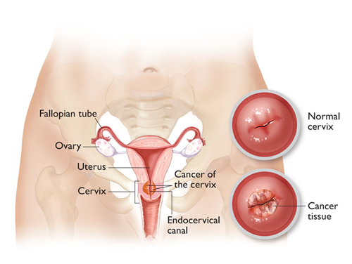 Cervical cancer