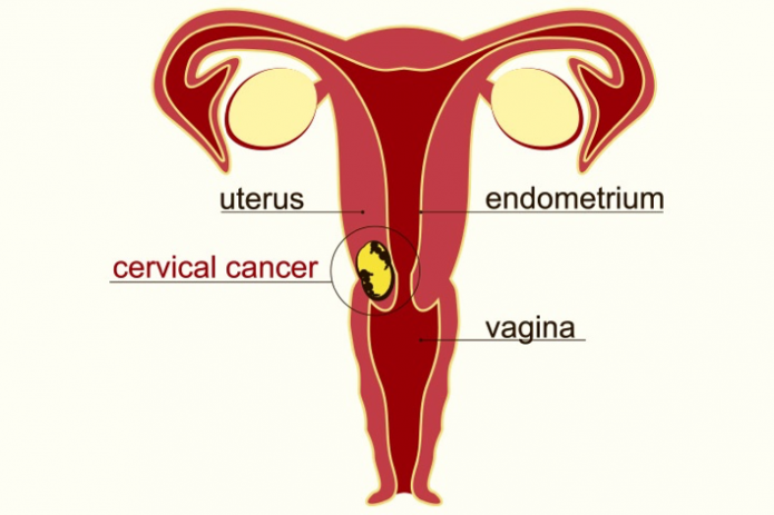 Cervical cancer: risk factors